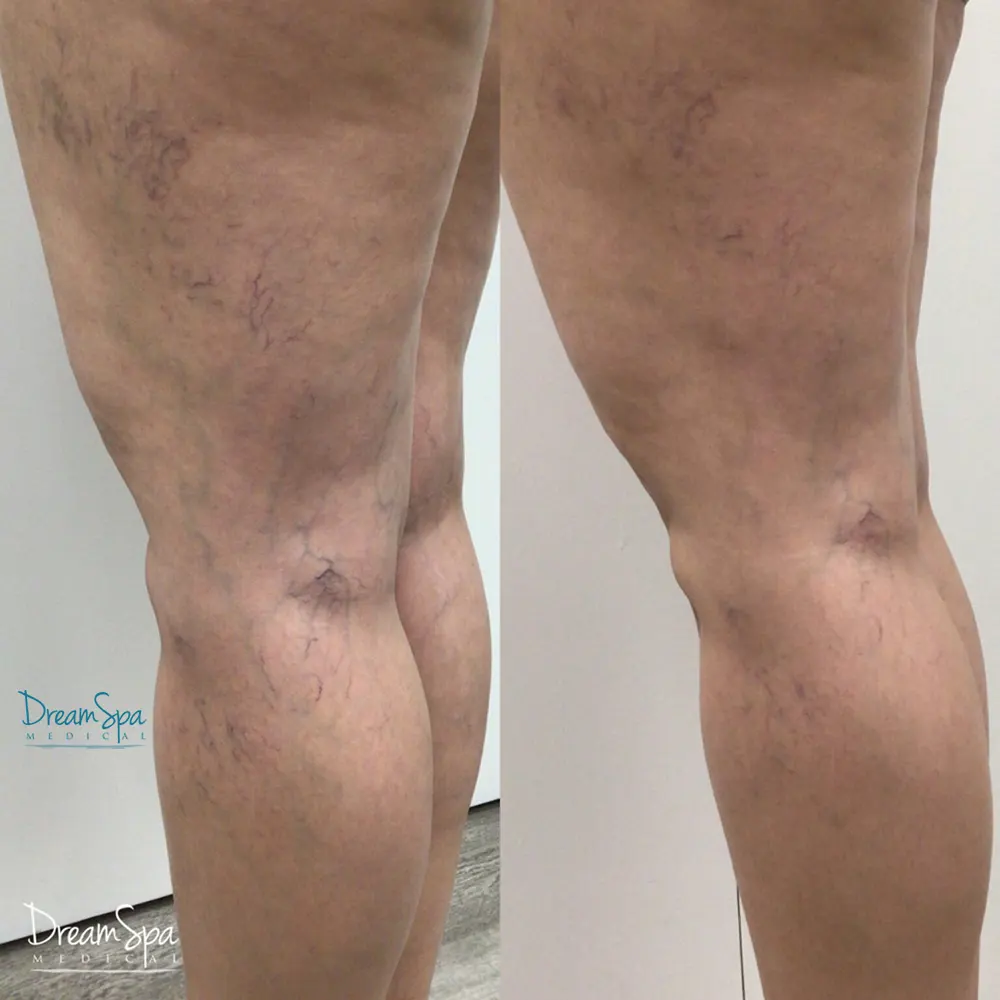 Sclerotherapy: Before and After Image