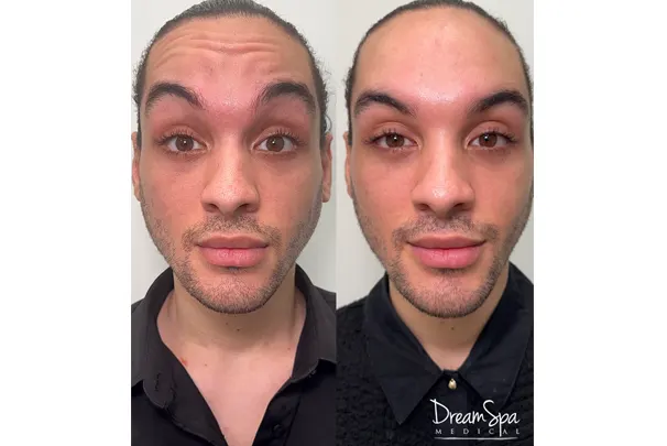 Botox Client at Dream Spa Medical - Before and After Image
